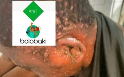 Variole du singe : cette photo a bien été prise à l’hôpital général de Référence à Kinshasa