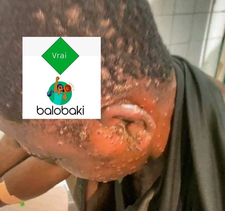 Variole du singe : cette photo a bien été prise à l’hôpital général de Référence à Kinshasa