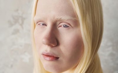 Non, les albinos ne sont pas les vecteurs de transmission des maladies de la peau
